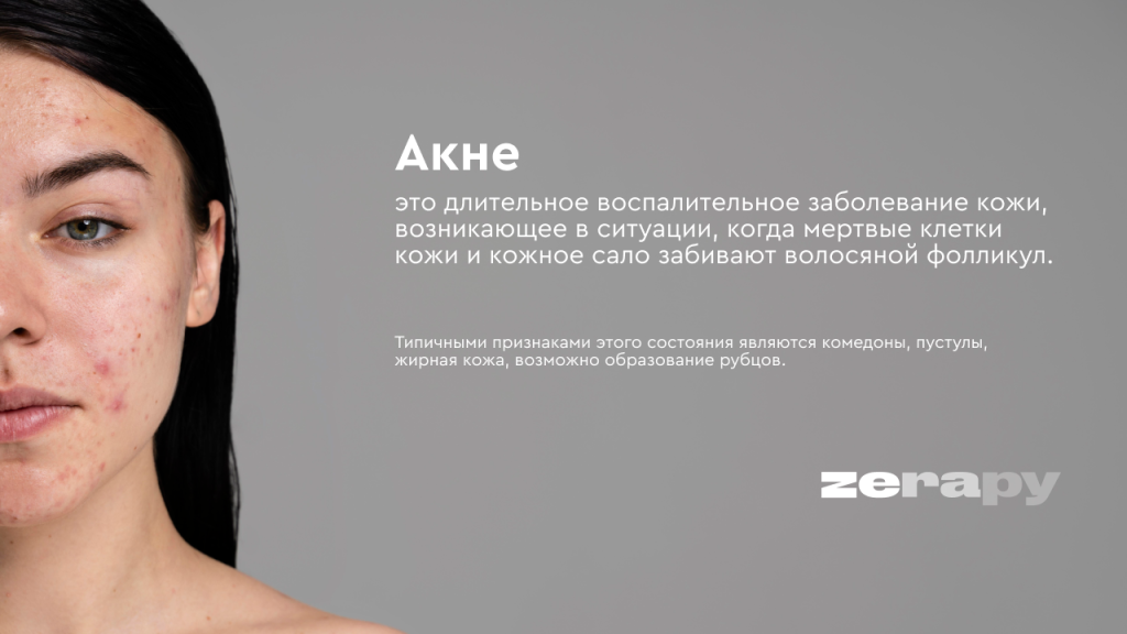 акне1