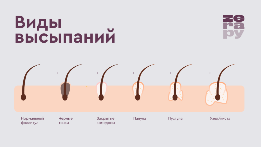 акне2